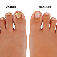 Lade das Bild in den Galerie-Viewer, PureNail - patentierte Nagelpilz-Therapie - für gesunde Nägel innerhalb von 4 Wochen